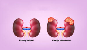 Kidney hospital in Chennai | Dialysis center in Chennai | Chennai Kidney Care